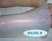 Plaque de BOLUSIL ® sur un bras