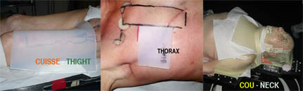 BOLUSIL ® appliqué sur la cuisse, le thorax et le cou