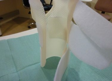 Orthèse et plaque de silicone BOLUFORMABLE ® après refroidissement