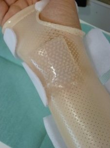 Orthèse avec silicone en place sur un poignet
